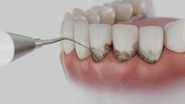 Trusted Wisdom Tooth Removal service in Des Plaines, IL - Dentist Open Now
